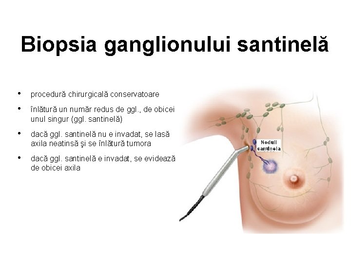 Biopsia ganglionului santinelă • procedură chirurgicală conservatoare • înlătură un număr redus de ggl.
