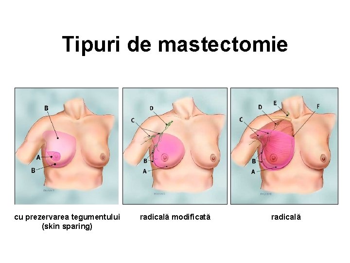 Tipuri de mastectomie cu prezervarea tegumentului (skin sparing) radicală modificată radicală 