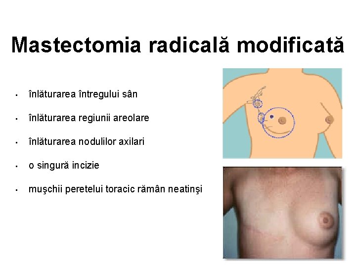 Mastectomia radicală modificată • înlăturarea întregului sân • înlăturarea regiunii areolare • înlăturarea nodulilor