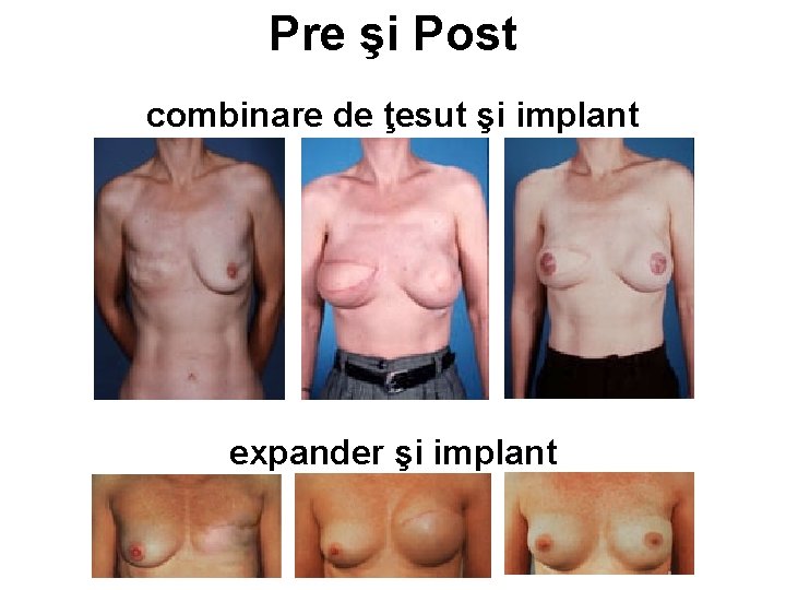Pre şi Post combinare de ţesut şi implant expander şi implant 