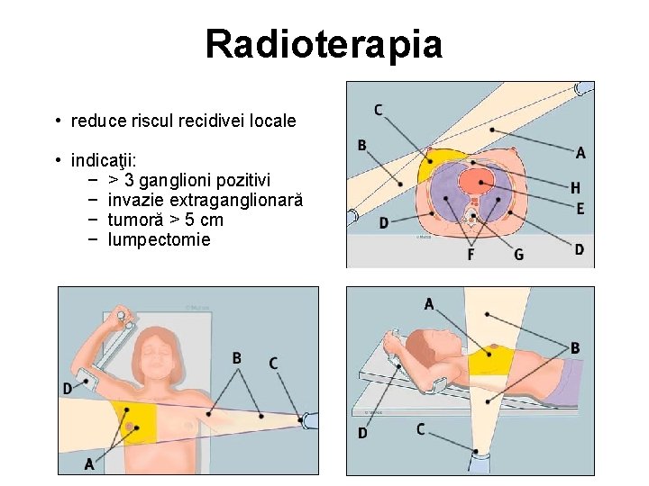 Radioterapia • reduce riscul recidivei locale • indicaţii: − > 3 ganglioni pozitivi −