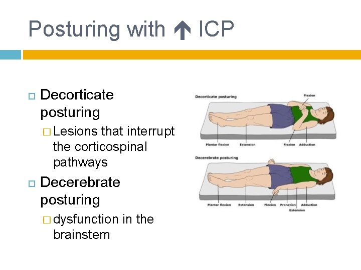 Posturing with ICP Decorticate posturing � Lesions that interrupt the corticospinal pathways Decerebrate posturing