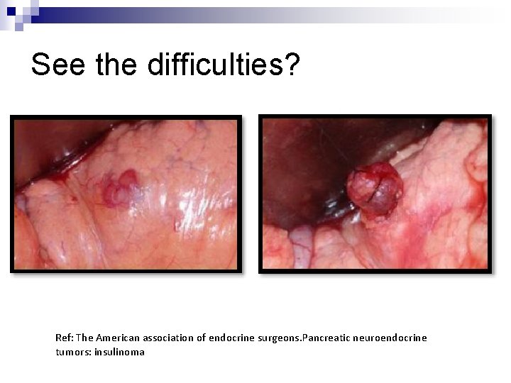 See the difficulties? Ref: The American association of endocrine surgeons. Pancreatic neuroendocrine tumors: insulinoma