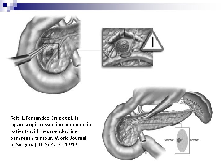 Ref: L. Fernandez-Cruz et al. Is laparoscopic ressection adequate in patients with neuroendocrine pancreatic