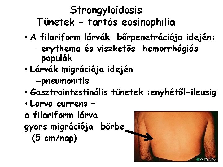 A strongyloidosis terjedt, Strongyloidosis (féreg fertőzés) - A strongyloidosis tünetek