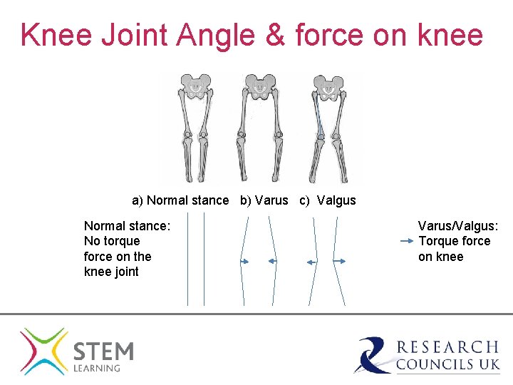 Knee Joint Angle & force on knee a) Normal stance b) Varus c) Valgus
