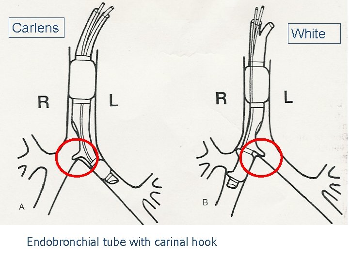 Carlens Endobronchial tube with carinal hook White 