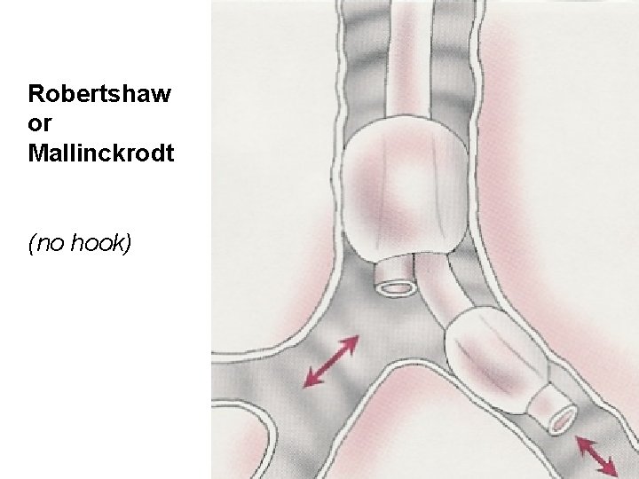 Robertshaw or Mallinckrodt (no hook) 