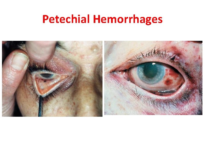 Petechial Hemorrhages 
