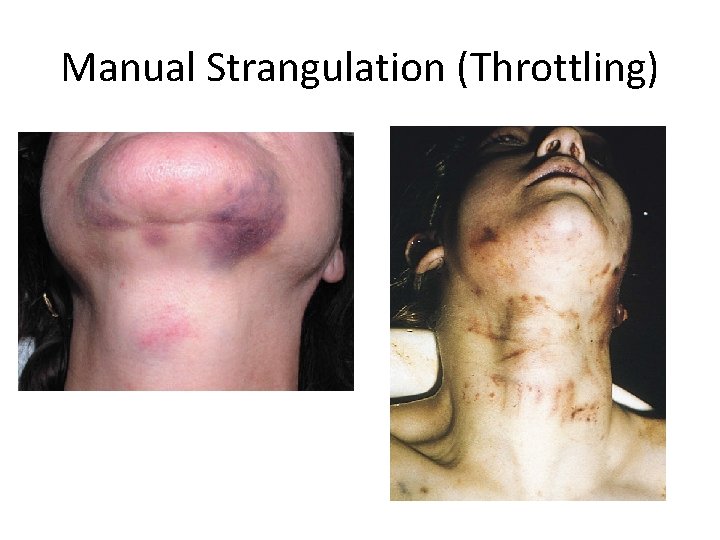 Manual Strangulation (Throttling) 