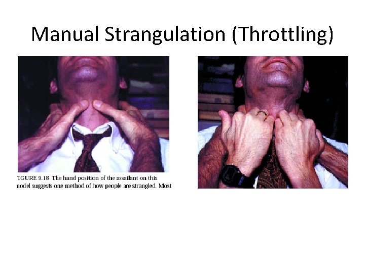 Manual Strangulation (Throttling) 