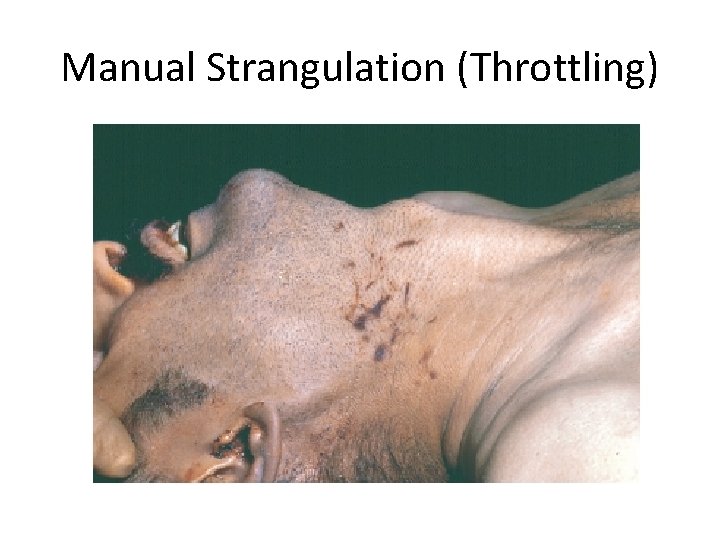 Manual Strangulation (Throttling) 