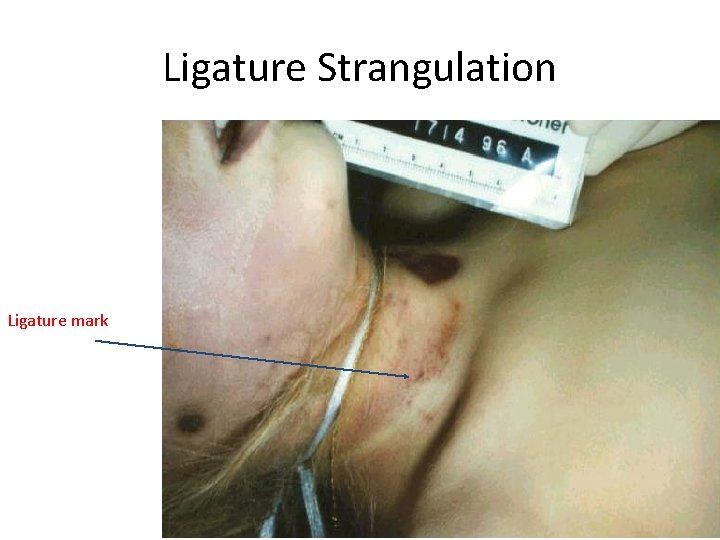 Ligature Strangulation Ligature mark 