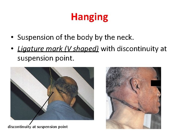 Hanging • Suspension of the body by the neck. • Ligature mark (V shaped)
