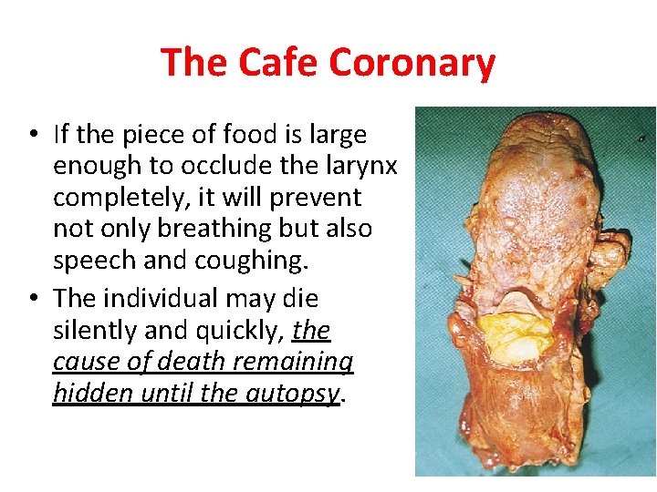 The Cafe Coronary • If the piece of food is large enough to occlude