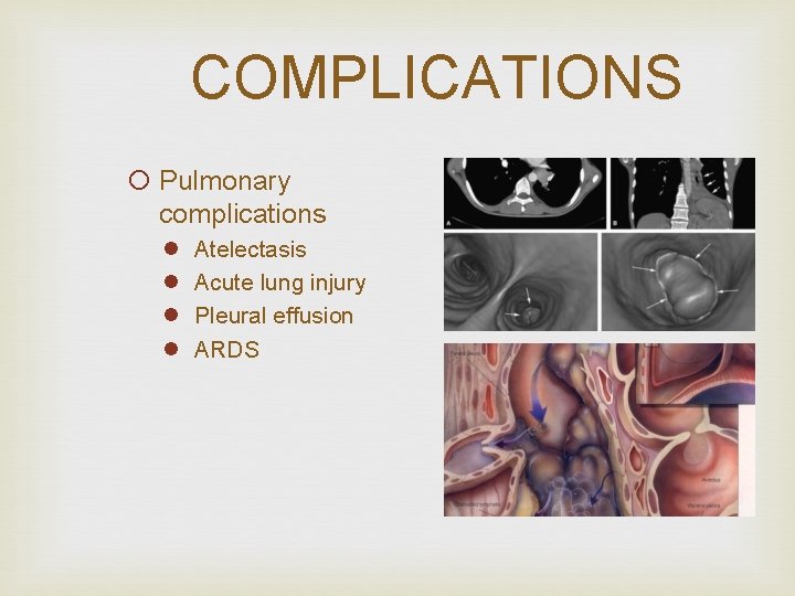 COMPLICATIONS ¡ Pulmonary complications l l Atelectasis Acute lung injury Pleural effusion ARDS 