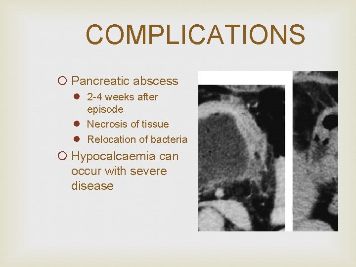 COMPLICATIONS ¡ Pancreatic abscess l 2 -4 weeks after episode l Necrosis of tissue