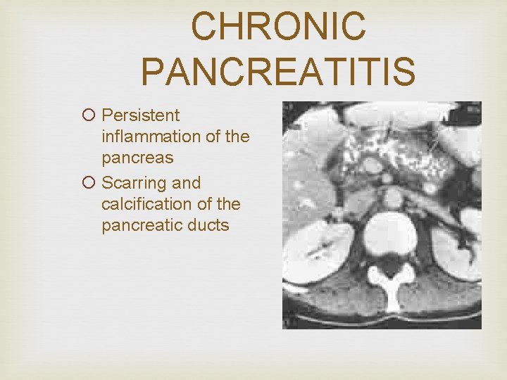 CHRONIC PANCREATITIS ¡ Persistent inflammation of the pancreas ¡ Scarring and calcification of the