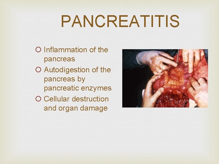 PANCREATITIS ¡ Inflammation of the pancreas ¡ Autodigestion of the pancreas by pancreatic enzymes