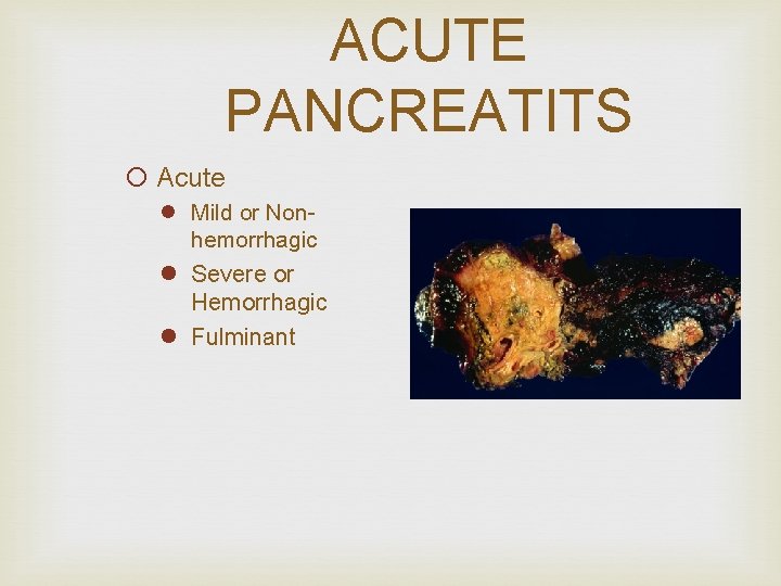 ACUTE PANCREATITS ¡ Acute l Mild or Nonhemorrhagic l Severe or Hemorrhagic l Fulminant