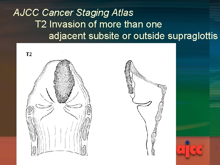 AJCC Cancer Staging Atlas T 2 Invasion of more than one adjacent subsite or AJCC Cancer Staging Atlas T 2 Invasion of more than one adjacent subsite or