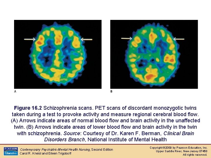 Causes of Schizophrenia Figure 16. 2 Schizophrenia scans. PET scans of discordant monozygotic twins