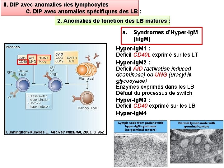 II. DIP avec anomalies des lymphocytes C. DIP avec anomalies spécifiques des LB :