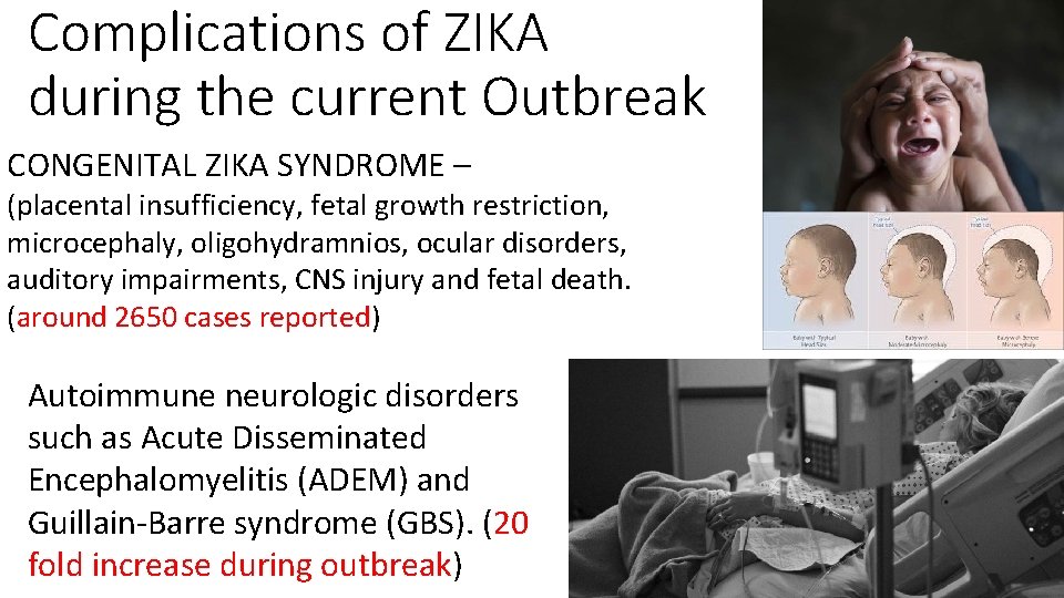 Complications of ZIKA during the current Outbreak CONGENITAL ZIKA SYNDROME – (placental insufficiency, fetal