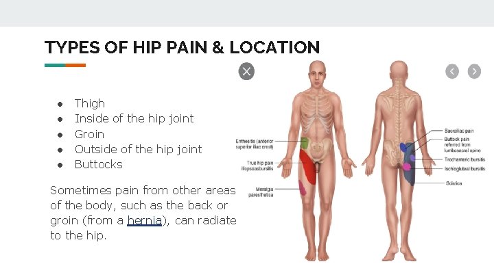 TYPES OF HIP PAIN & LOCATION ● ● ● Thigh Inside of the hip