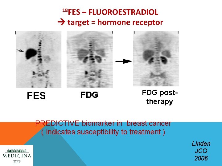18 FES – FLUOROESTRADIOL target = hormone receptor FES FDG posttherapy PREDICTIVE biomarker in