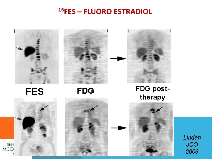 18 FES – FLUORO ESTRADIOL FDG posttherapy Linden JCO 2006 