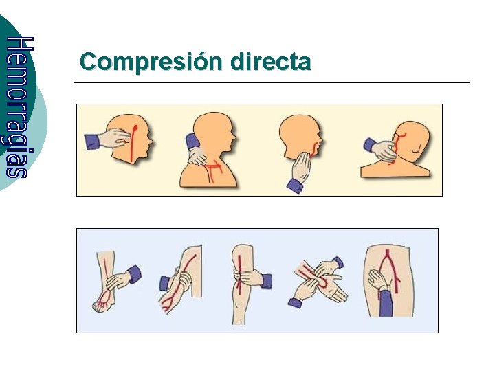 Compresión directa 