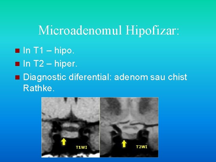 Microadenomul Hipofizar: In T 1 – hipo. n In T 2 – hiper. n