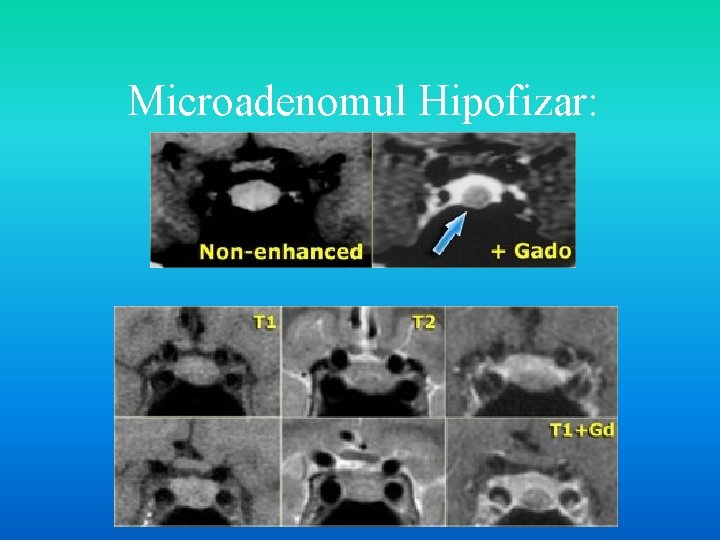 Microadenomul Hipofizar: 