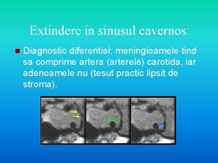 Extindere in sinusul cavernos: n Diagnostic diferential: meningioamele tind sa comprime artera (arterele) carotida,