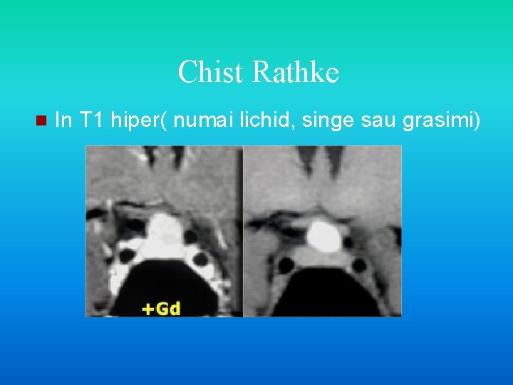 Chist Rathke n In T 1 hiper( numai lichid, singe sau grasimi) 