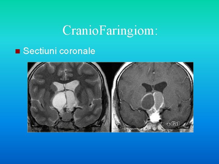 Cranio. Faringiom: n Sectiuni coronale 