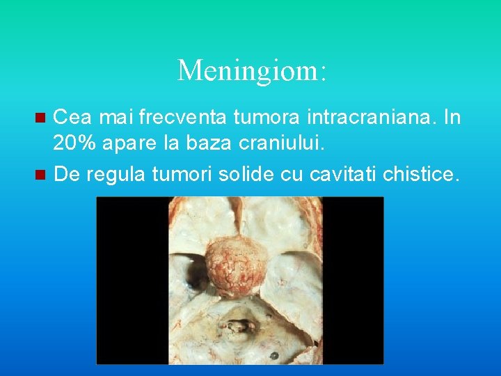 Meningiom: Cea mai frecventa tumora intracraniana. In 20% apare la baza craniului. n De