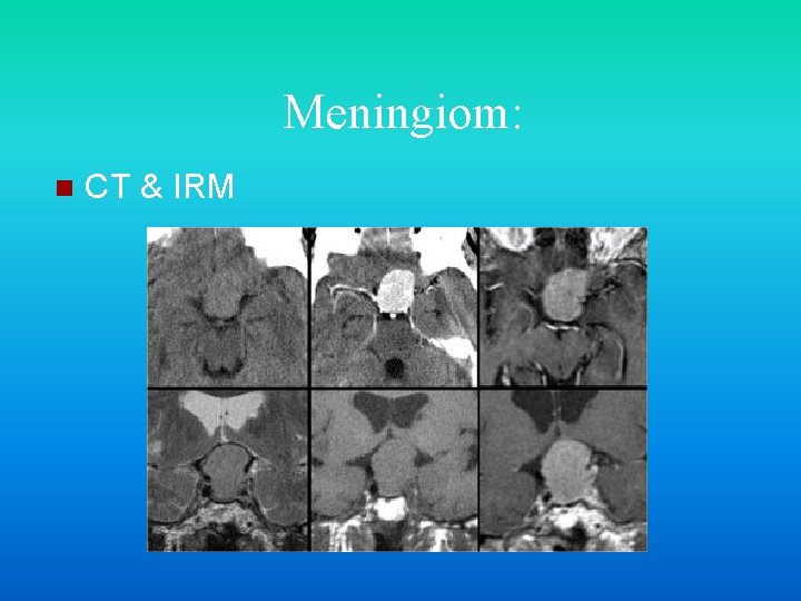 Meningiom: n CT & IRM 