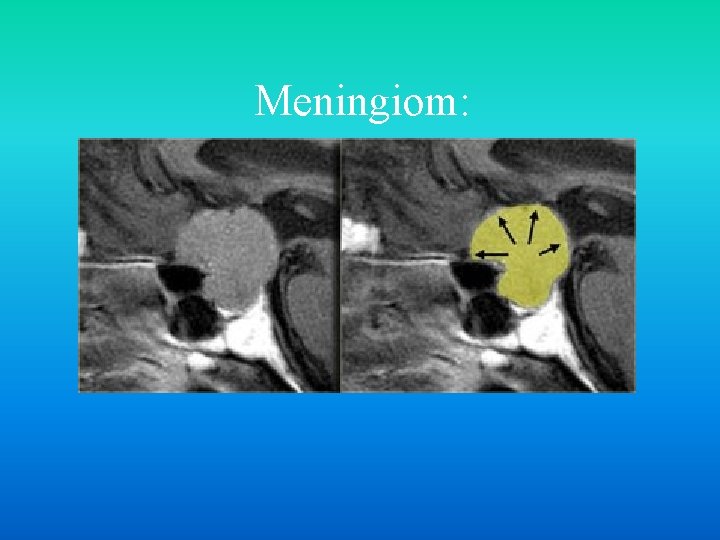 Meningiom: 