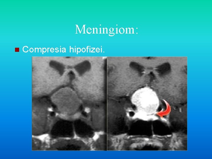 Meningiom: n Compresia hipofizei. 