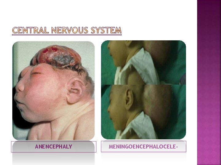 ANENCEPHALY MENINGOENCEPHALOCELE- 