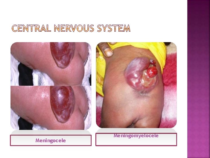 Meningocele Meningomyelocele 