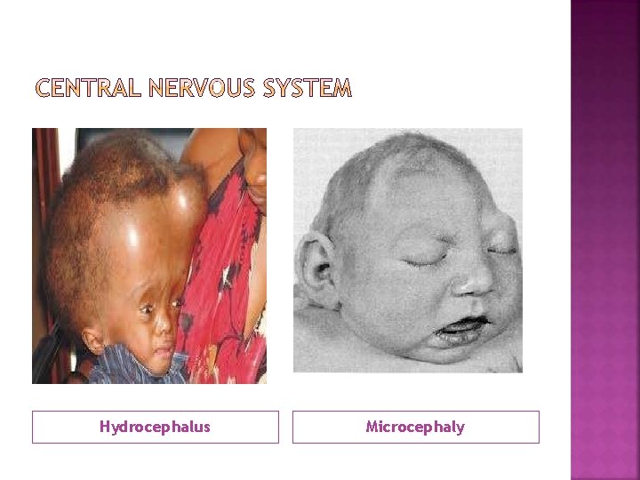 Hydrocephalus Microcephaly 