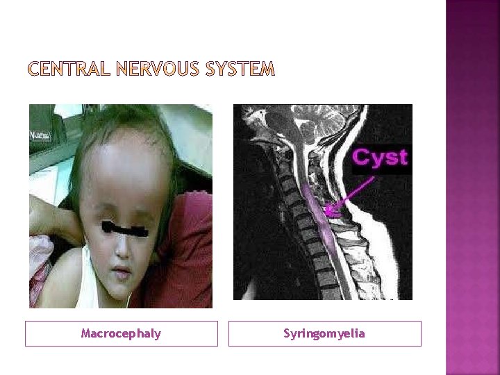 Macrocephaly Syringomyelia 