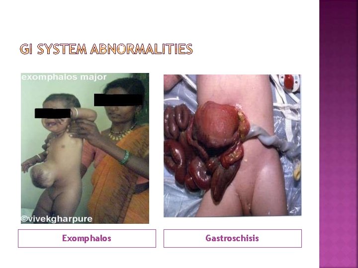 Exomphalos Gastroschisis 