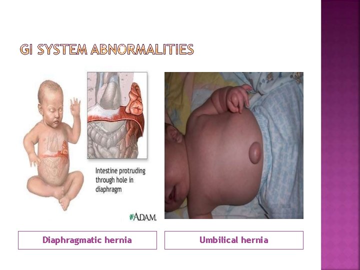 Diaphragmatic hernia Umbilical hernia 