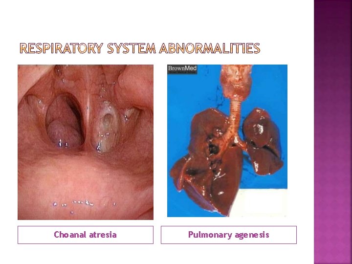 Choanal atresia Pulmonary agenesis 