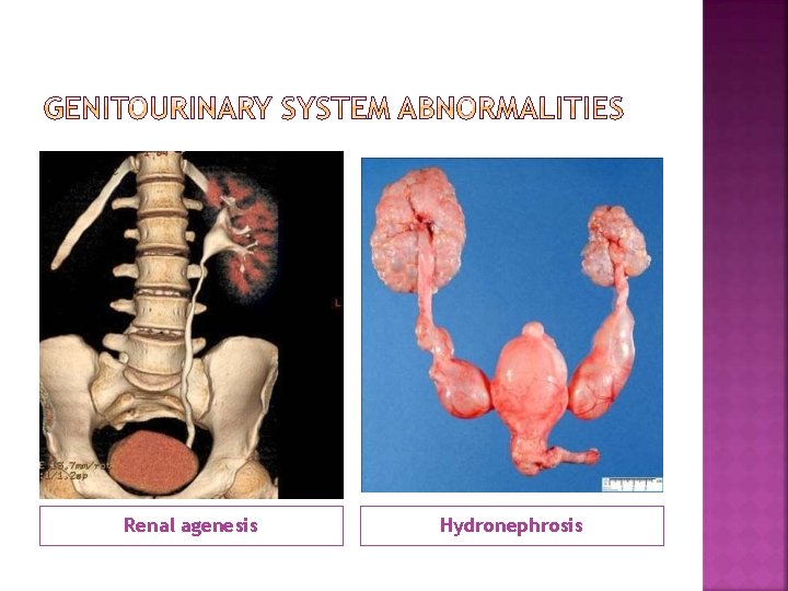 Renal agenesis Hydronephrosis 