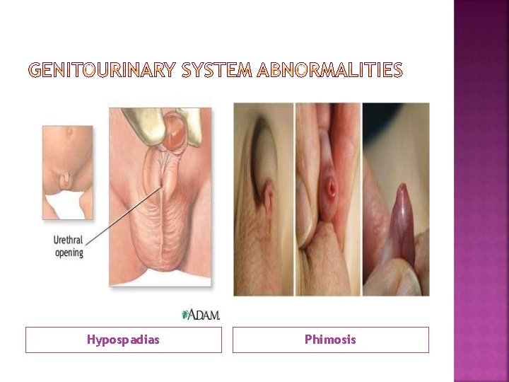 Hypospadias Phimosis 